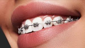 Orthodontic
