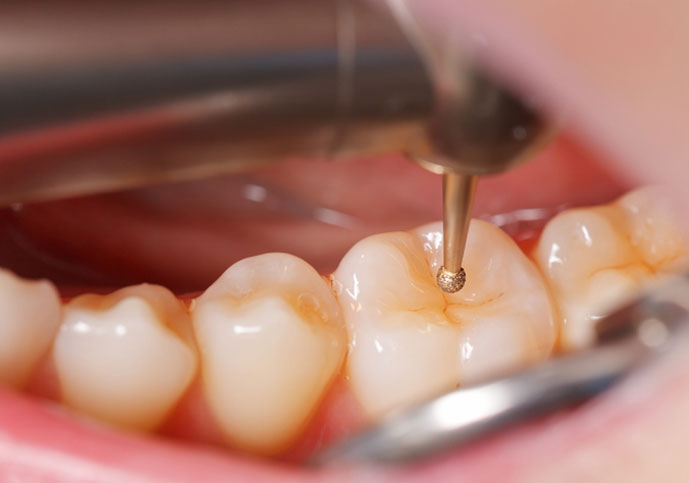 Fillings and Restoration